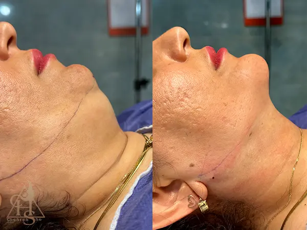 ساکشن غبغب با نتایجی ماندگار در کلینیک زیبایی چهره شو