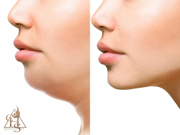بررسی معایب و محدودیتهای ساکشن و هایفو غبغب