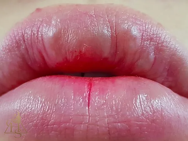 گلوله شدن ژل و ایجاد گره در لب