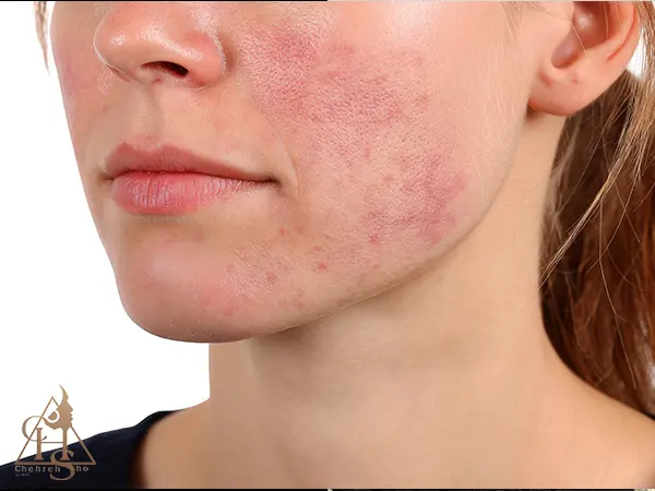 احتمال بروز واکنش‌های شدید به دلیل تزریق فیلر در دوران بارداری