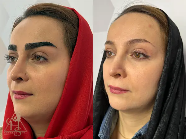 ماندگاری نتایج کاشت ابرو به روش میکروگرافت