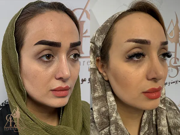 کاشت ابرو با روش منحصربه‌فرد هر زیباجو در چهره شو