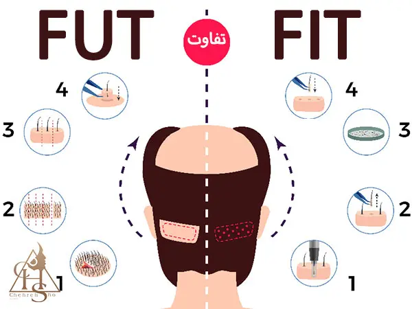 مزایا و معایب کاشت ابرو با جراحی