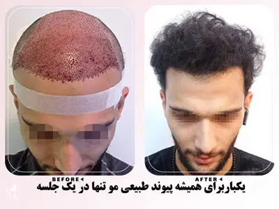 نمونه کار کاشت مو با پیوند طبیعی مو