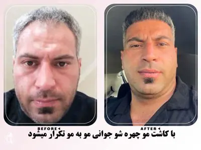 نمونه کار کاشت مو برای جوانی چهره