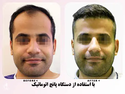 نمونه کار کاشت مو با دستگاه پانچ اتوماتیک