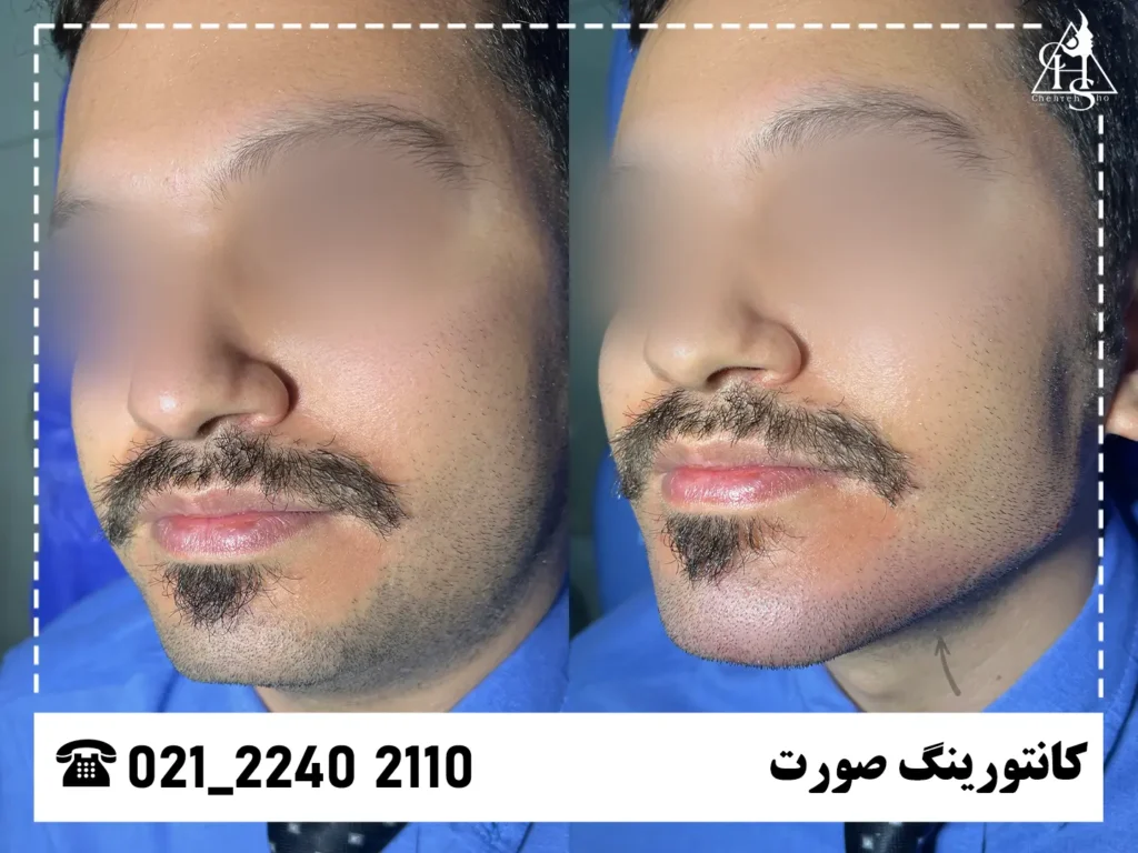 عکس کانتورینگ صورت کلینیک چهره شو