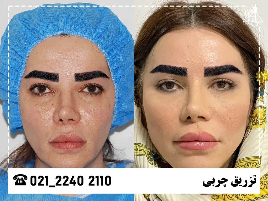 عکس کانتورینگ صورت کلینیک چهره شو 3