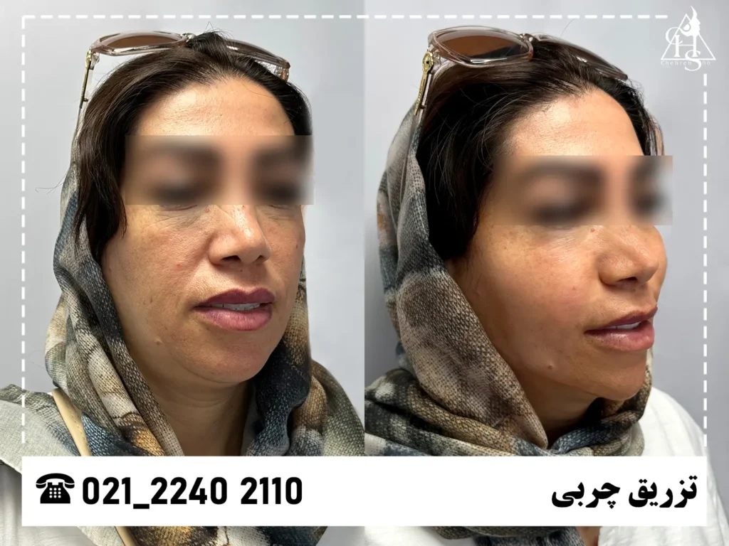 عکس تزریق چربی کلینیک چهره شو 4