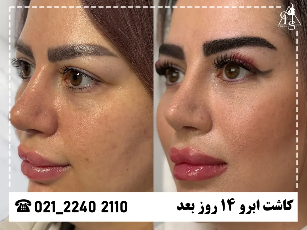 عکس کاشت ابرو کلینیک چهره شو 16
