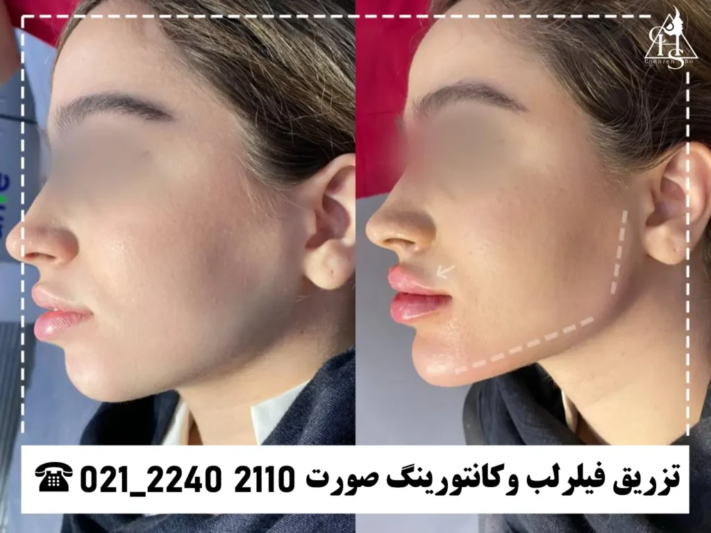 عکس تزریق فیلر لب کلینیک چهره شو 10