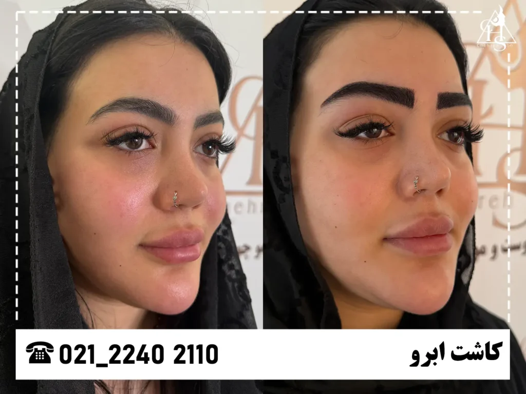 عکس کاشت ابرو کلینیک چهره شو 18