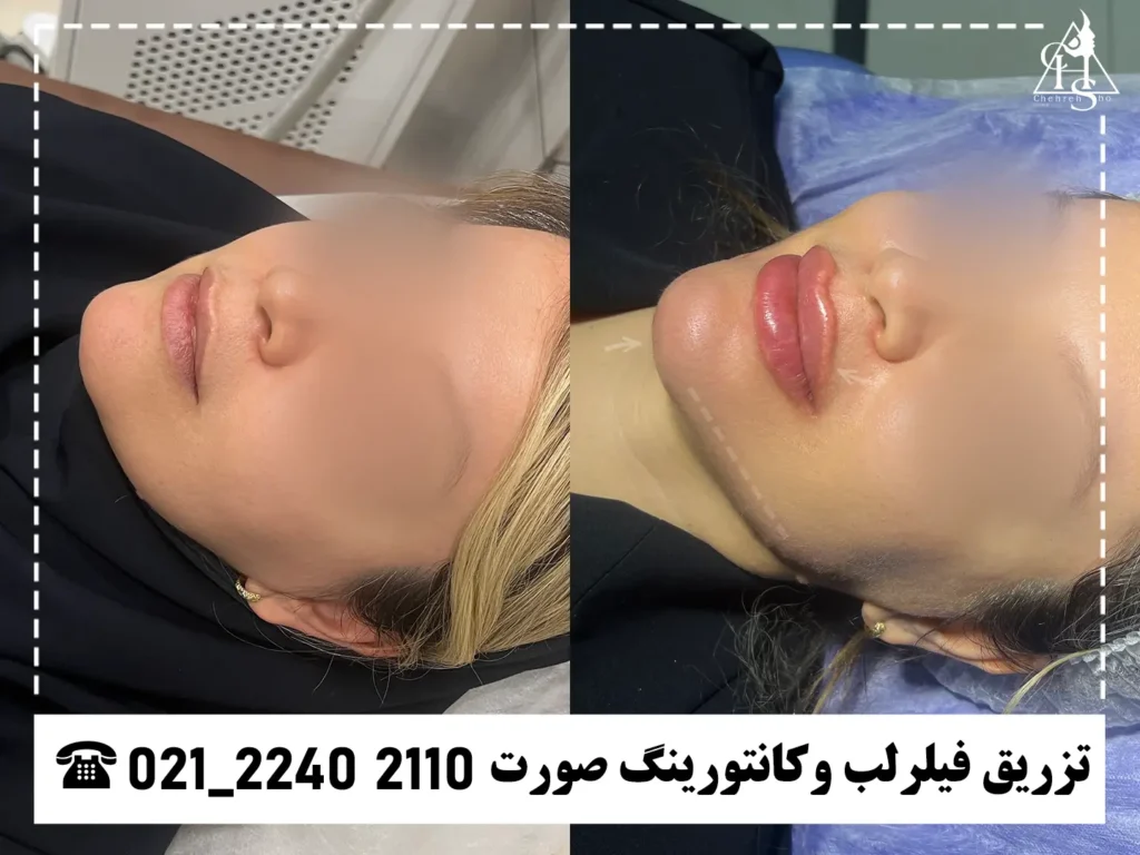 عکس کانتورینگ صورت کلینیک چهره شو 7