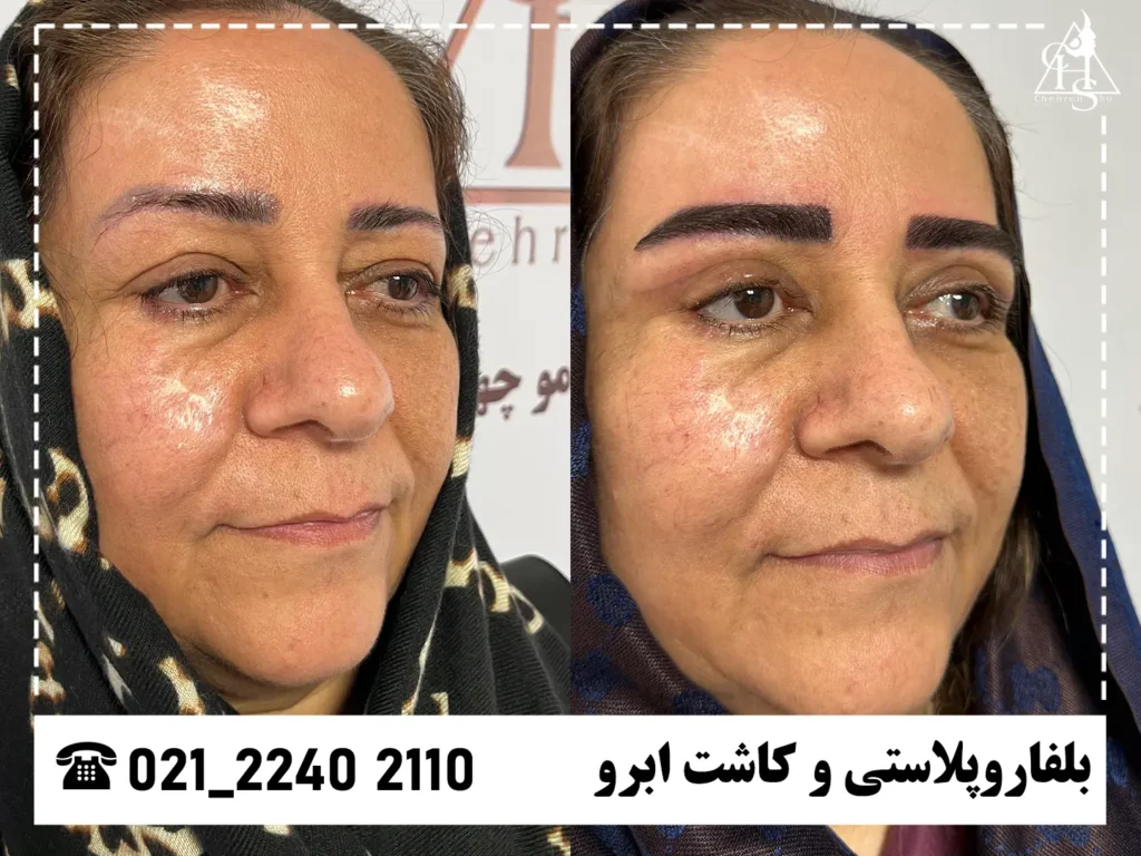 عکس بلفاروپلاستی کلینیک چهره شو 2