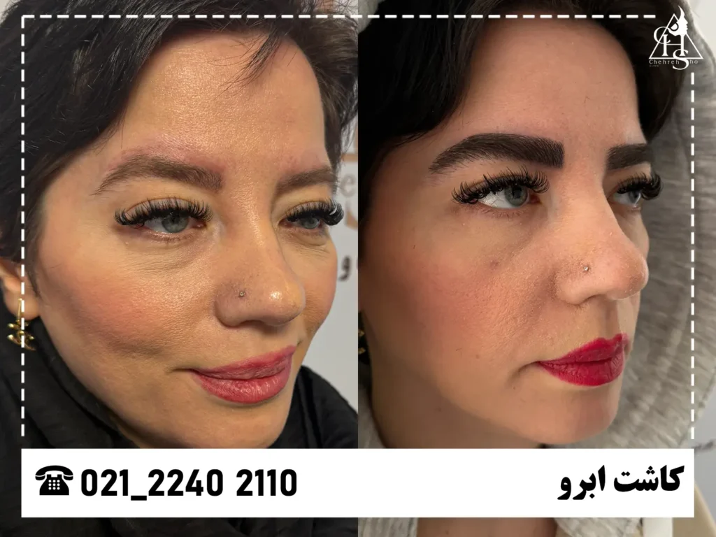 عکس کاشت ابرو کلینیک چهره شو 21