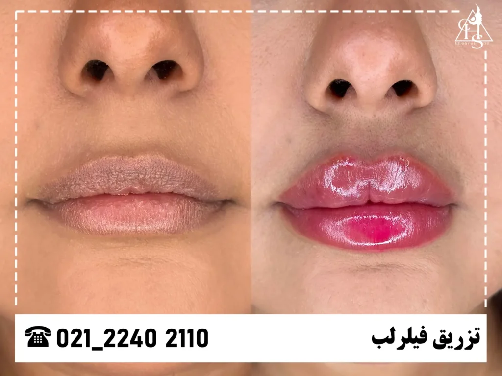 عکس تزریق فیلر لب کلینیک چهره شو 6