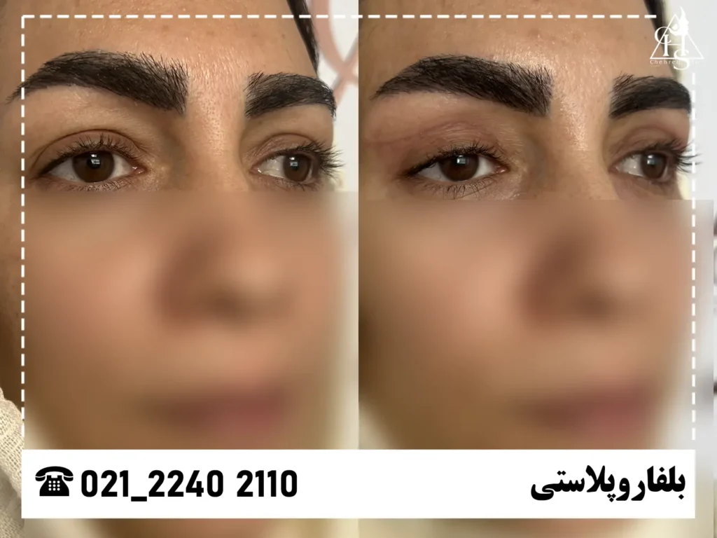 عکس بلفاروپلاستی کلینیک چهره شو