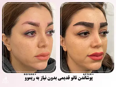 نمونه کاشت ابرو 20