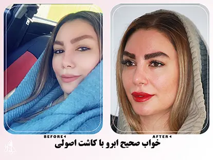 نمونه کاشت ابرو 22