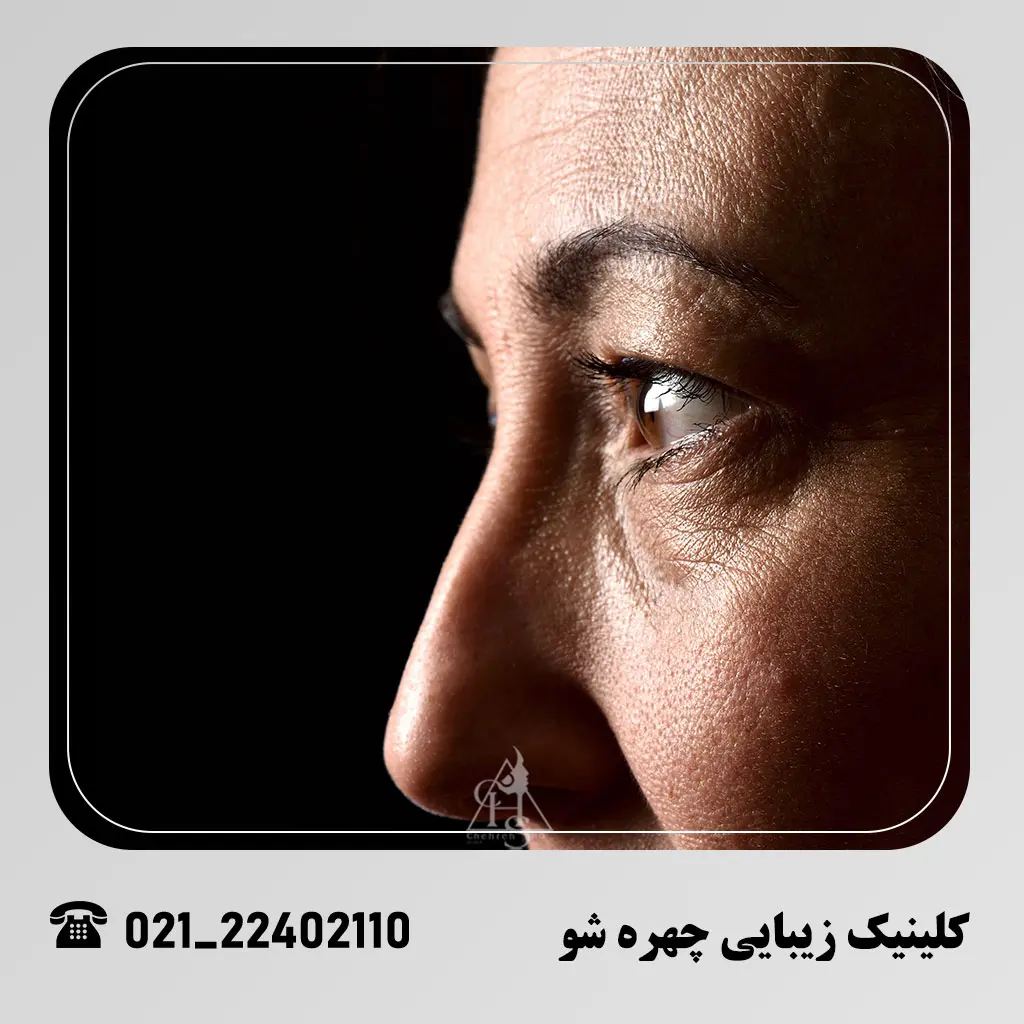 بلفاروپلاستی و زیبایی پلک در کلینیک چهره شو
