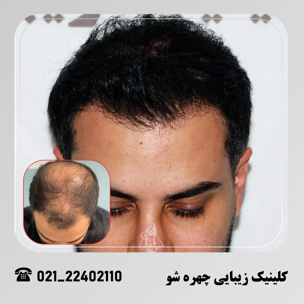 تصویر قبل و بعد از کاشت مو در کلینیک زیبایی چهره شو