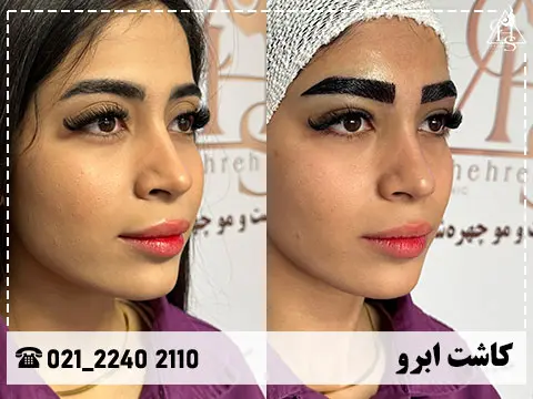 نمونه کاشت ابرو 16