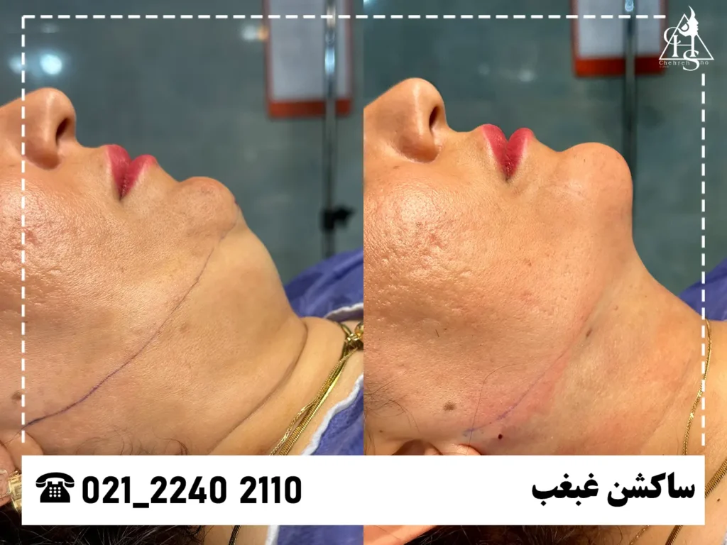 ساکشن غبغب کلینیک چهره شو 5