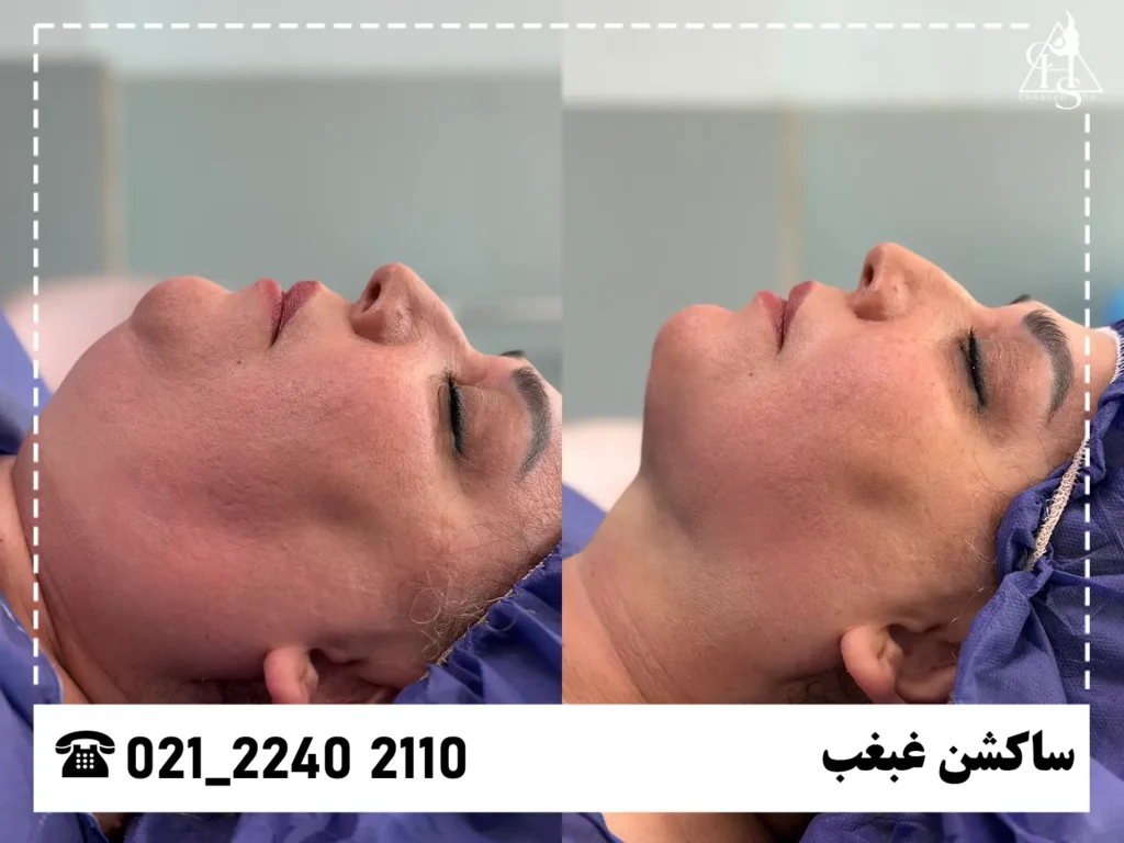 ساکشن غبغب کلینیک چهره شو 6