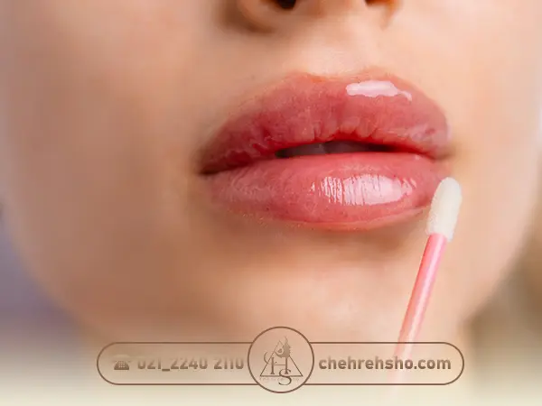 ورم لب بعد از تزریق ژل