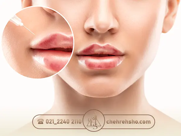 عکس کبودی بعد از تزریق ژل لب