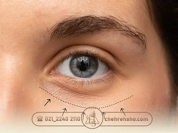 بهترین پزشک برای تزریق ژل زیر چشم
