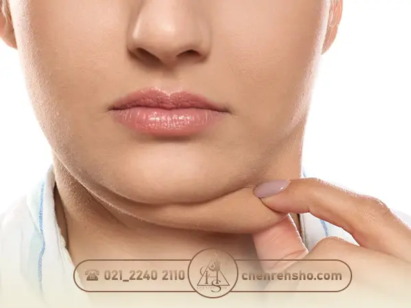 ورم کردن غبغب پس از ساکشن