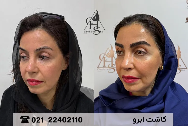 آلبوم جامع تصاویر قبل و بعد کاشت