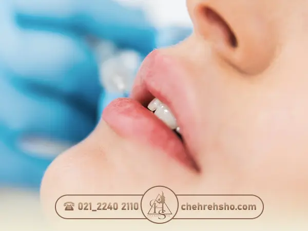 میزان ژل موردنیاز برای تزریق به لب