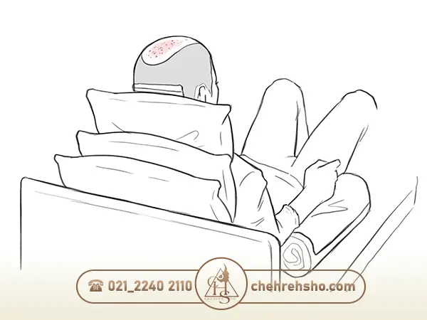 خوابیدن در حالت نشسته پس از کاشت مو