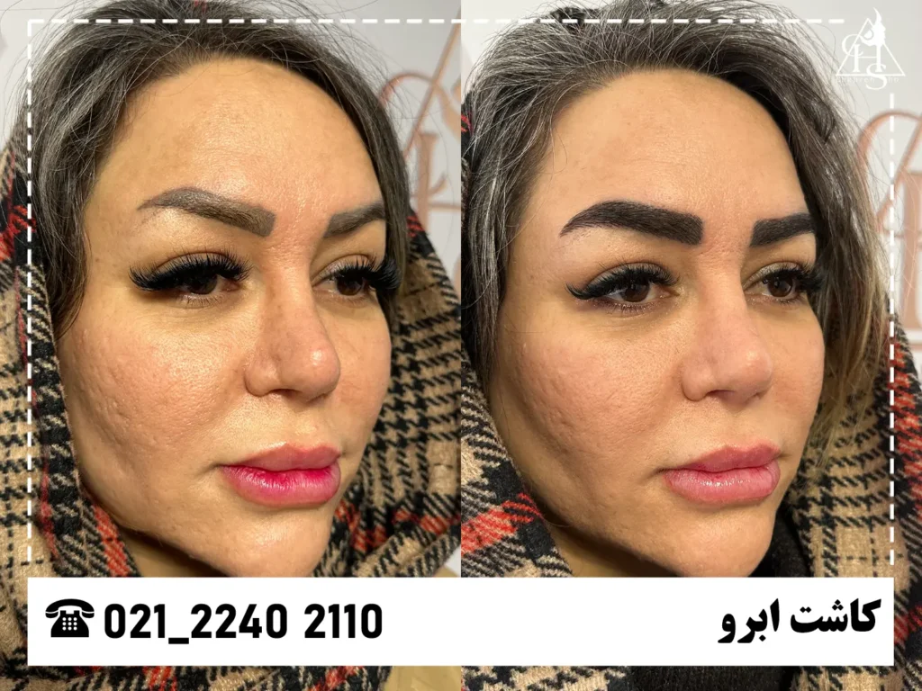 تصاویر کاشت ابرو 9