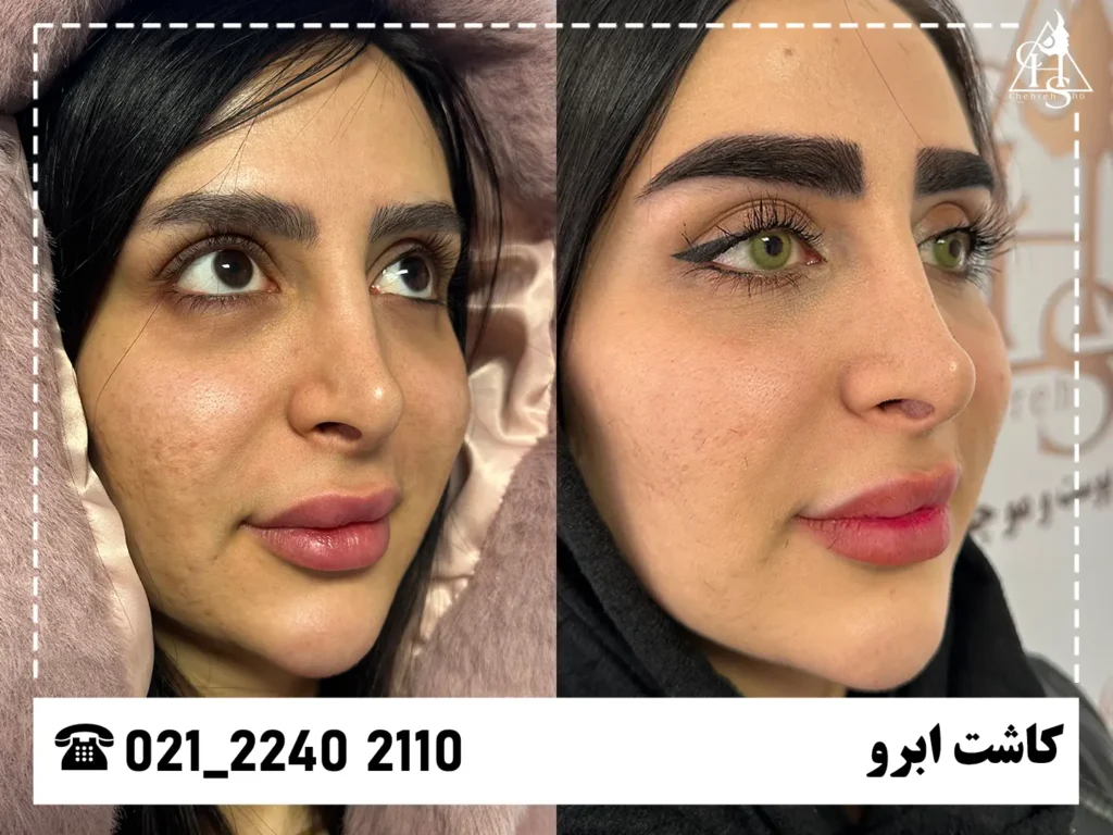 تصاویر کاشت ابرو 3