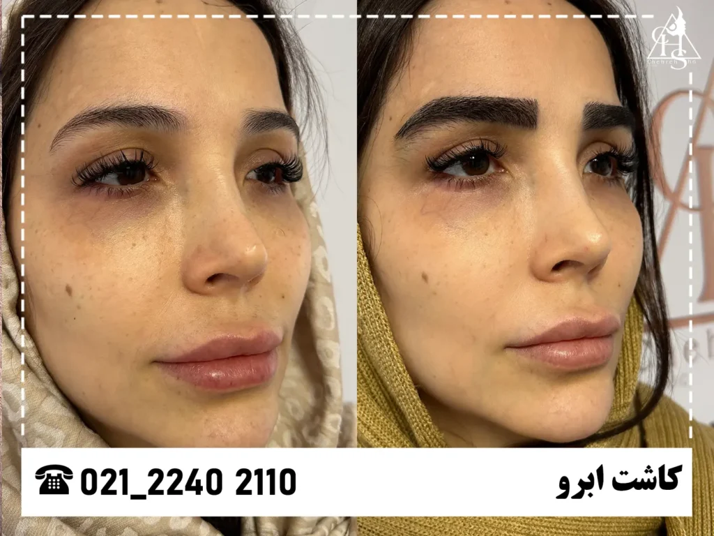تصاویر کاشت ابرو 4