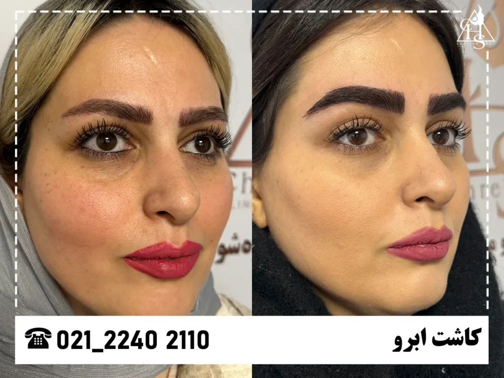 تصاویر کاشت ابرو 6
