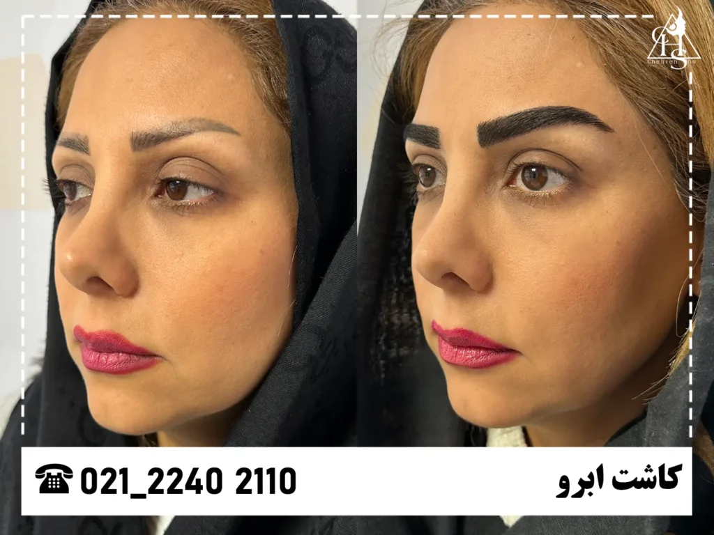 تصاویر کاشت ابرو 7