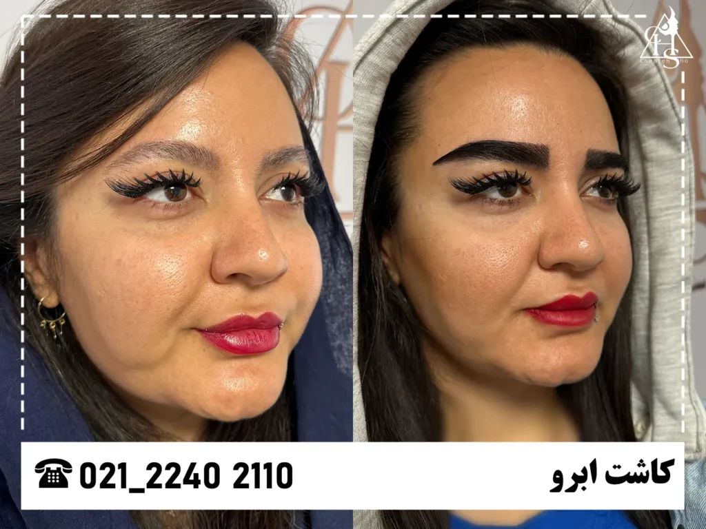 تصاویر کاشت ابرو 8