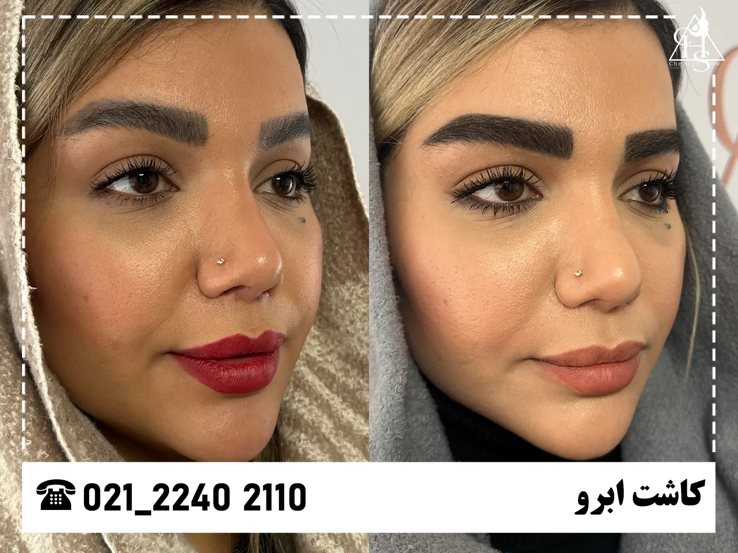 تصویر کاشت ابرو — نمونه ۱