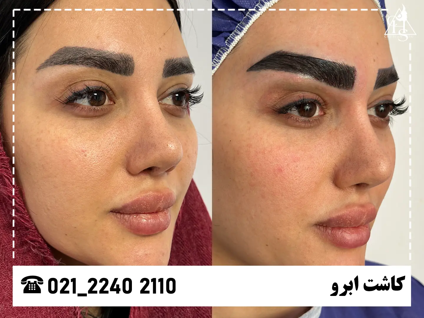 تصویر کاشت ابرو — نمونه ۲