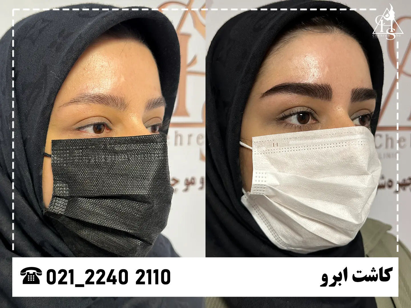 تصویر کاشت ابرو — نمونه ۴