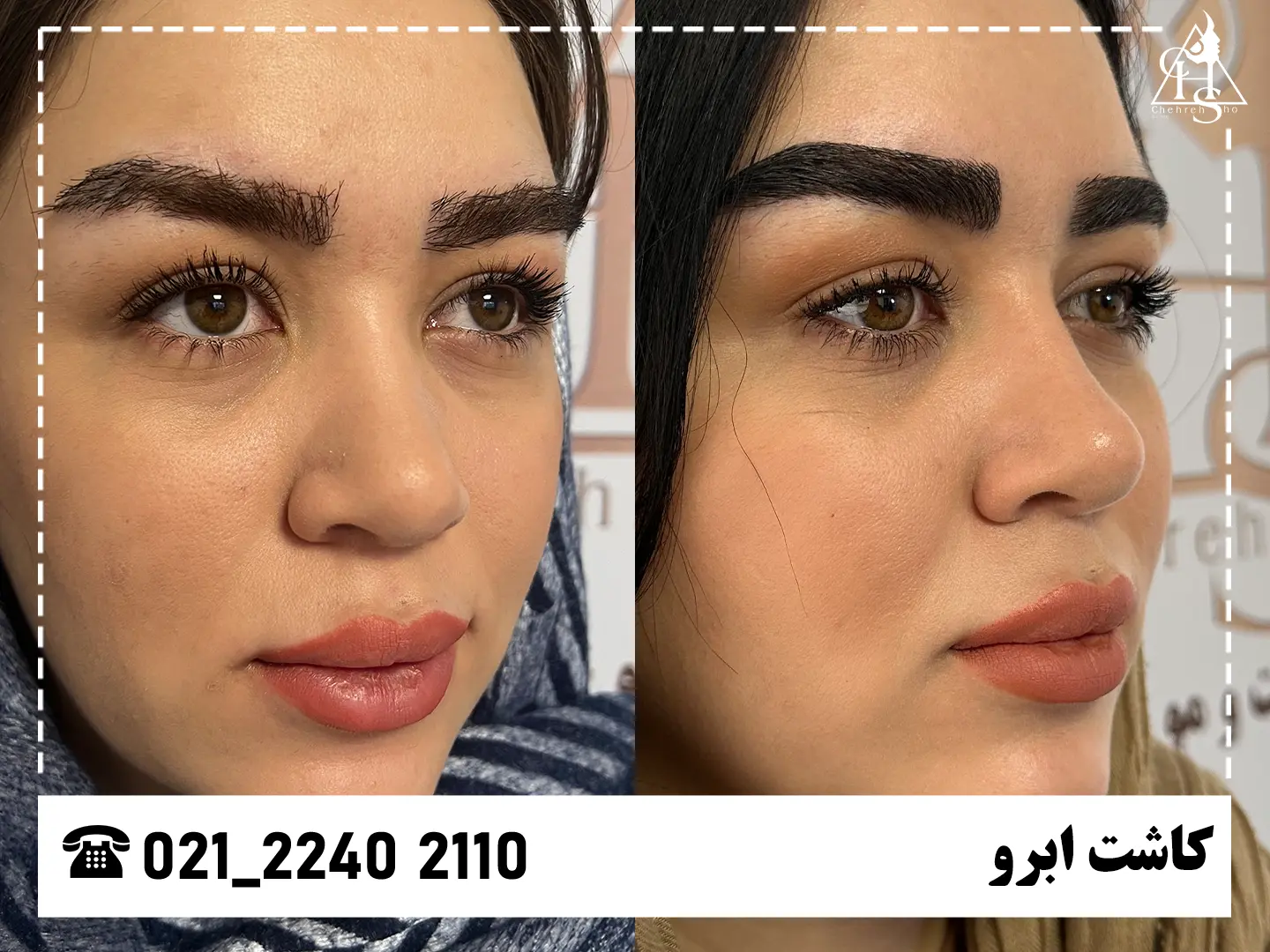 تصویر کاشت ابرو — نمونه ۵