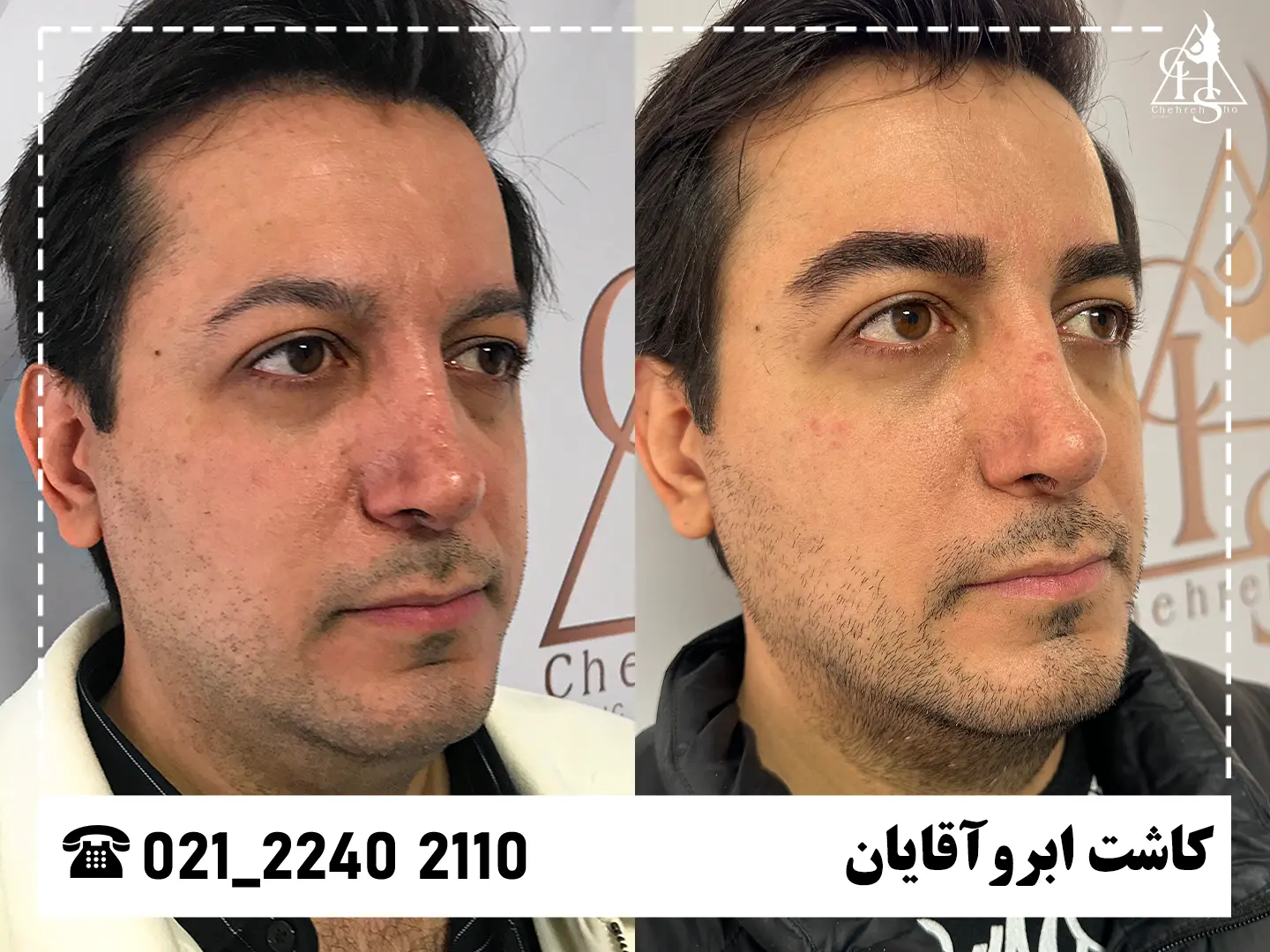تصویر کاشت ابرو — نمونه ۶