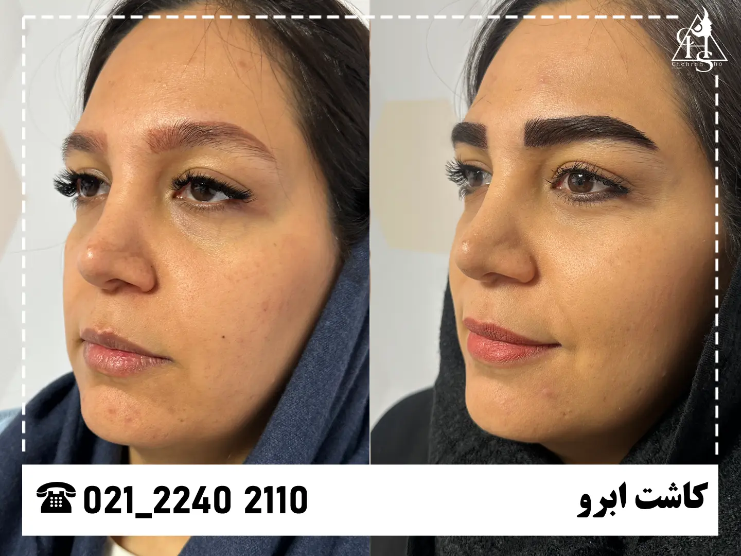 تصویر کاشت ابرو — نمونه ۸