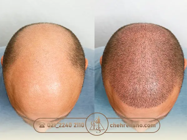 تاثیرات روزه گرفتن بر نتیجه کاشت مو