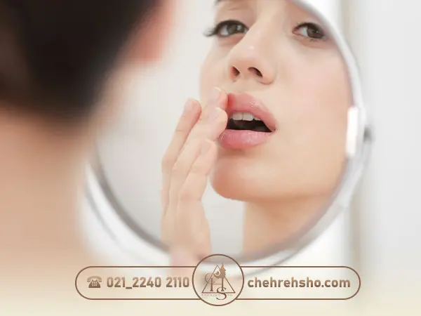 تبخال زدن پس از تزریق ژل لب