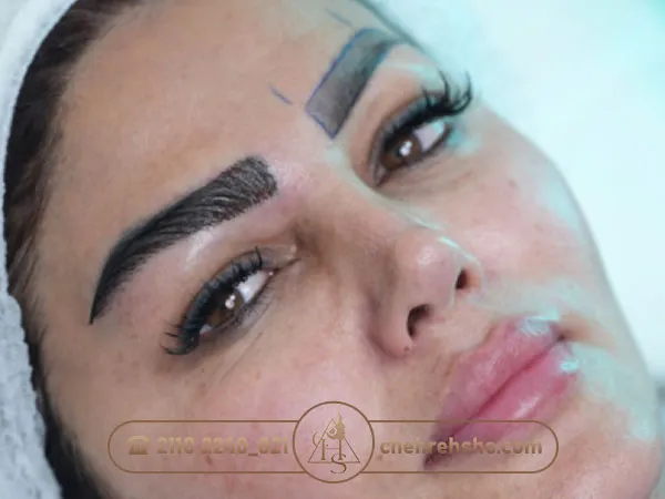 لیفت ابرو بعد از کاشت